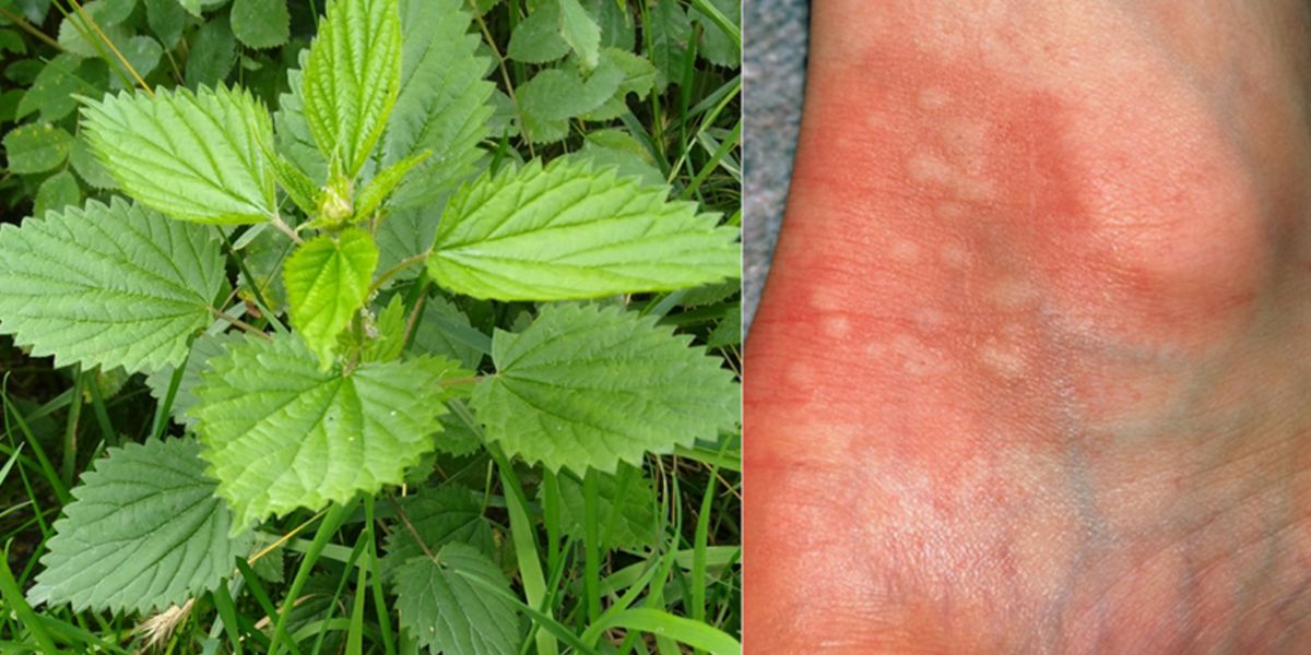 Brennnessel (Urtica) und Hautausschläge