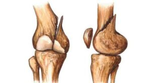 Lebensmittel zur Heilung von Knochenbrüchen