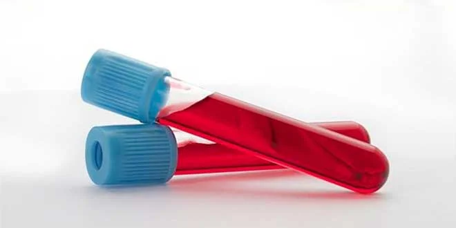 Seltsame Parameter in den Analysen bei der Verwendung von Steroiden Seltsame Parameter in den Analysen bei der Verwendung von Steroiden